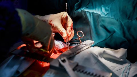 Aorta-Operation (Symbolbild): Eine Chirurgenhand arbeitet im OP mit einer Pinzette am geöffneten Brustkorb