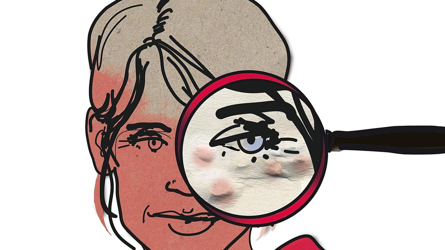 Illustration "Die Diagnose" zum Thema Hyaluron und Corona-Impfung: Das Auge einer Frau unter einer Lupe