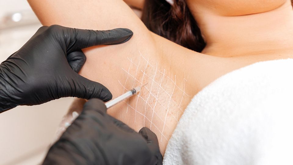 Die Injektion des Nervengifts Botulinum-Toxin, kurz Botox, unter die Haut lähmt die Muskeln und damit die Schweißdrüsen. Diese Technik ist auch für Hände und Füße geeignet. Botox-Spritzen bei Achselschwitzen zahlt mittlerweile die Krankenkasse bei entsprechender Indikation. 