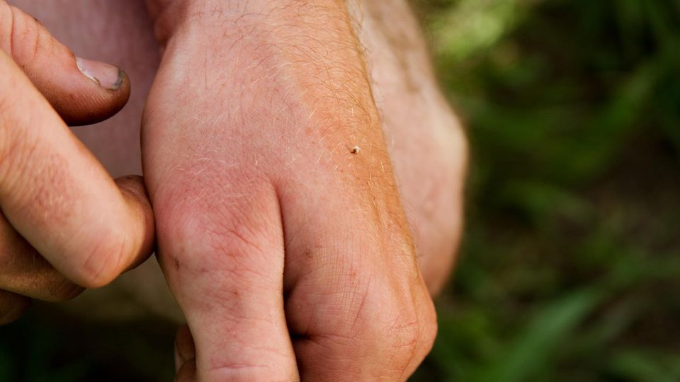 Bee sting: stings in the hand Bee sting: stings in the hand