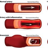 Schwachstelle der Silver-Surfer ab 65: die Bauchschlagader  Die Hauptschlagader, die Aorta,  ist mit einem Durchmesser von zwei Zentimetern die größte blutführende "Leitung" im Körper. Über sie gelangt das sauerstoffreiche Blut vom Herzen in den Körper. Den Teil der Hauptschlagader, der durch den Bauchraum führt, wird Bauchschlagader genannt. Wenn sich die Bauchschlagader an einer Stelle ausdehnt, spricht man von einem Aneurysma. Meist sind diese Ausbuchtungen harmlos, doch wachsen sie weiter an, können sie reißen – mit letalen Folgen. Der rasche Blutverlust führt binnen Sekunden zur Ohnmacht und zum tödlichen Kreislaufversagen. Eine Rettung gibt es nicht. Das Risiko steigt mit dem Alter. Wer nahe Verwandte mit einem Aneurysma hat, trägt ebenfalls ein höheres Risiko. Die Vorsorge wird per Ultraschall durchgeführt. Sollte ein Aneurysma erkannt werden, lässt es sich operativ behandeln. Seit 2018 ist für Männer ab 65 Jahren die einmalige Ultraschalluntersuchung zur Früherkennung eines Bauchaortenaneurysmas kostenlos.   Wegen ihrer großen Bedeutung wird die Aorta in den Chirurgie-Leitlinien seit Kurzem als eigenständiges Organ geführt.Davon sollen vor allem die Patienten profitieren. Zurzeit wird die Schlagader in vielen Kliniken noch von unterschiedlichen Fachgebieten versorgt: Herzchirurgen operieren den herznahen Teil im Brustkorb, Gefäßchirurgen nehmen die Eingriffe an der Bauchaorta vor. Künftig soll die Therapie in Krankenhäusern gebündelt werden, in denen Ärztinnen und Ärzte besonders viele OPs an der Aorta durchführen, um mehr Routine und eine bessere Versorgungsqualität zu erreichen.