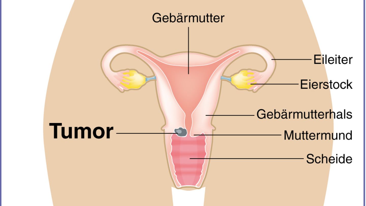 Früherkennung von Gebärmutterhalskrebs (Pap-Abstrich) Früherkennung von Gebärmutterhalskrebs (Pap-Abstrich)