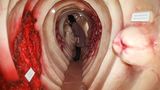 Darmkrebs-Vorsorge: Mit Stuhlprobe ...  Anschaulicher geht es nicht: Das Bild zeigt das begehbare Modell des Darms samt der möglichen Krankheiten. Bei Frauen ist Darmkrebs die zweithäufigste Krebsart, bei Männern die dritthäufigste. Nicht rechtzeitig erkannt endet die Erkrankung in der Regel tödlich. Dabei erkranken Männer früher und häufiger an der der bösartigen Veränderung der Schleimhaut, meist im Dickdarm und im Enddarm. Ihr Risiko steigt zudem mit dem Alter. Bereits ab 50 wird die Vorsorge daher von den Kassen getragen.  Ab 50 sollte man alles fünf Jahre eine Darmspiegelung einplanen. Die Methode ist sehr treffsicher und kann verhindern, dass Darmkrebs entsteht, da schon Vorstufen entfernt werden können. Neben der aufwändigen Darmspiegelung lässt sich mögliches Tumorgeschehen auch über eine Stuhlprobe ermitteln. Beim Arzt bekommt man drei Testkärtchen oder Röhrchen für Stuhlproben. Wird im Labor der Blutfarbstoff Häm im Stuhl nachgewiesen, kann das auf einen Darmtumor hinweisen.  Allerdings kam In Studien heraus, dass der Test rund die Hälfte der Tumoren nicht erkennt. Obendrein schlägt er sehr oft Fehlalarm: Von zehn Untersuchungen mit einem Tumorbefund erweisen sich fünf bis acht später als falsch. Viele Faktoren wie der Verzehr von Blutwurst oder Brokkoli können den Test verfälschen. Trotzdem verhindert er unterm Strich Darmkrebstodesfälle, wenn auch minimal. Immunologische Stuhltests, die selbst bezahlt werden müssen, finden zwar mehr Tumoren, produzieren aber noch häufiger blinden Alarm.