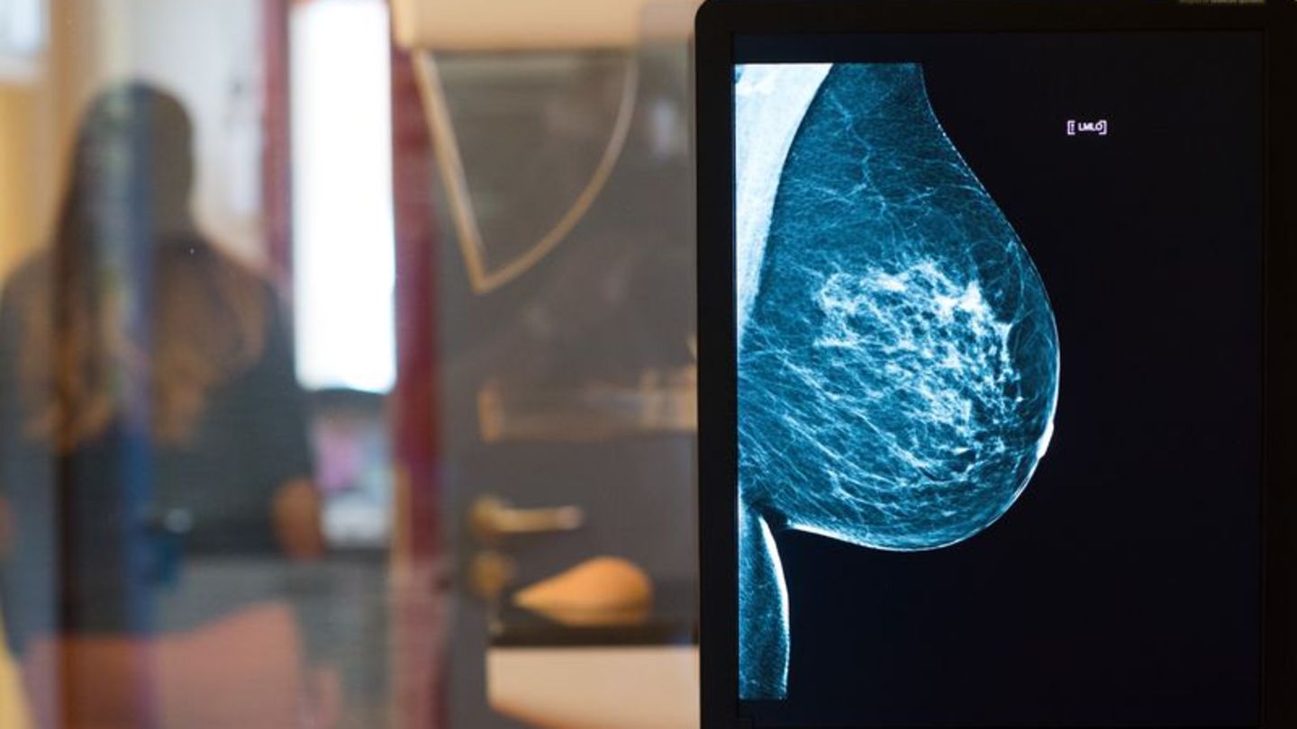 Gesundheit: Frauen können erweiterte Brustkrebsfrüherkennung nutzen