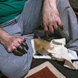 Abgefrorene Finger eines iranischen Trägers