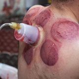 Iranischer Träger beim Schröpfen