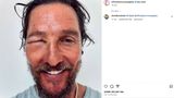 Vip News: Matthew McConaughey zeigt sich mit geschwollenem Auge