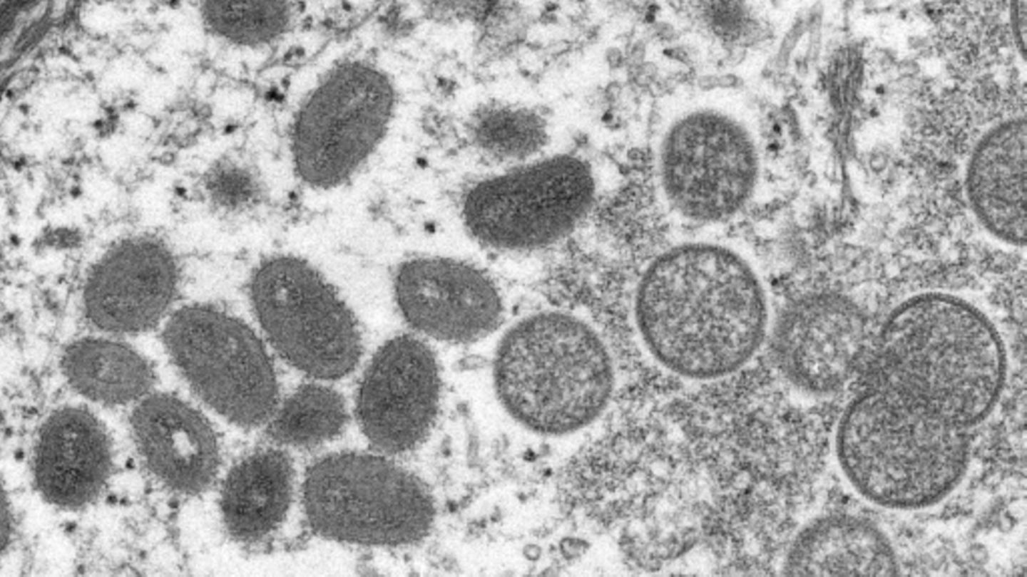Sprunghafter Anstieg der Mpox-Infektionen im Kongo - WHO befürchtet Ausbreitung