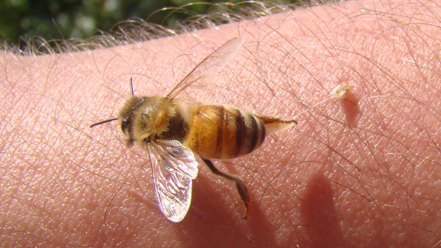 Bienenstich behandeln: Bienen hinterlassen den Stachel samt Giftblase in der Haut