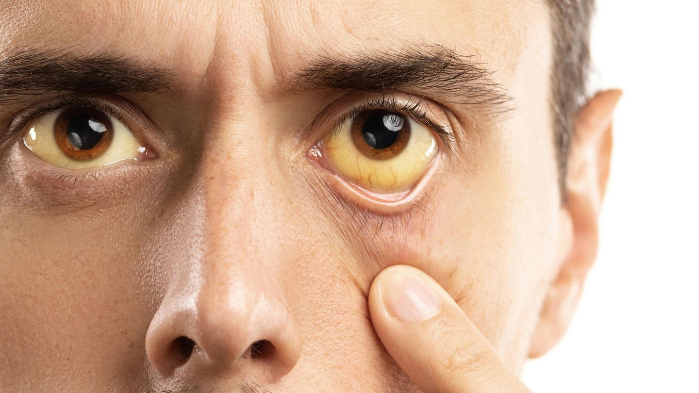 Eine Leberentzündung wird oft mit gelben Augen in Verbindung gebracht. Das ist zwar richtig, doch bei weitem nicht das einzige Symptom.