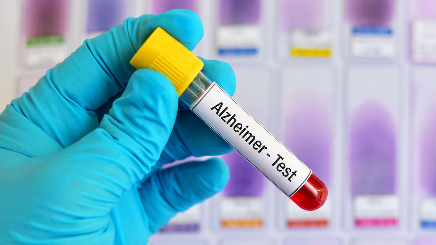 Demenz-Diagnose: Kommt bald der Alzheimer-Bluttest?