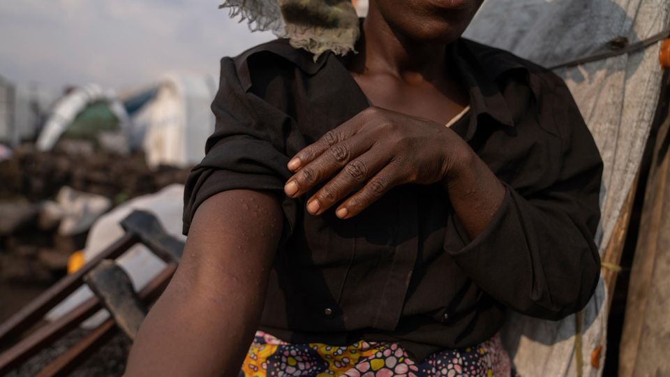 Eine schwarze Frau weist auf den Hautaufschlag auf ihrem rechten Oberarm – ein Mpox-Symptom