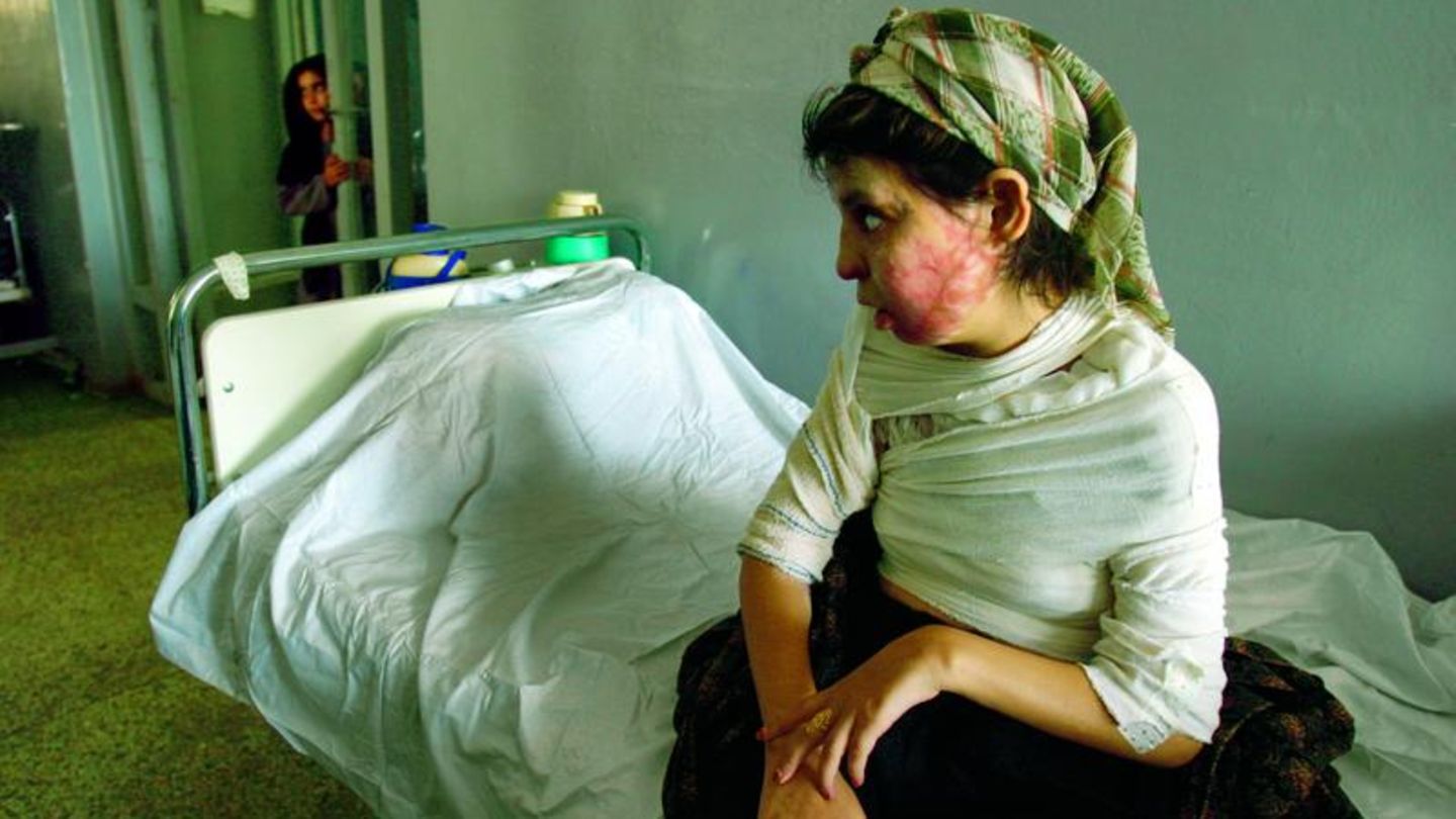 Die 16-jährige Fariba in der Krankenstation für Schwerstverbrannte in der afghanischen Stadt Herat, 2004. Sie übergoss sich mit Petroleum und zündete sich an, um der Strafe ihres Vaters zu entgehen. Im Afghanistan der Taliban haben Frauen kaum Rechte