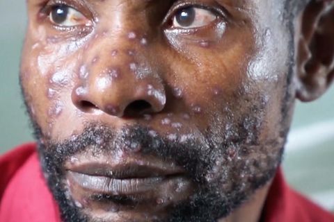 Kongo: Mpox-Überlebender berichtet