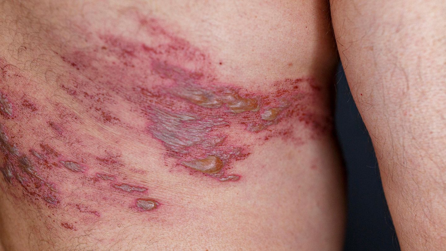 Gürtelrose klingt harmlos, ist jedoch eine Entzündung der Nerven mit entsprechend starken Schmerzen. Schon ein Luftzug auf der Haut oder die Reibung des T-Shirts können Schmerzattaken auslösen. 