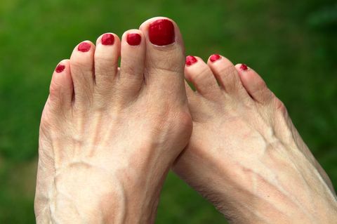 Hallux valgus: Zwei Füße mit einem Ballenzeh