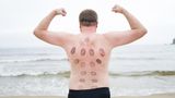 Ein weißer Mann zeigt seinen Rücken voller Blutergüsse stolz
