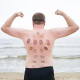 Ein weißer Mann zeigt seinen Rücken voller Blutergüsse stolz