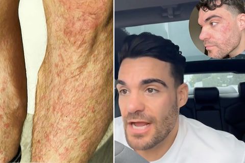 Viele Deutsche sind von der Hautkrankheit betroffen, so auch der bekannte Influencer Stefano Zarrella. Dagegen gibt es inzwischen ein Medikament, das Zarrella ausgestestet hat.