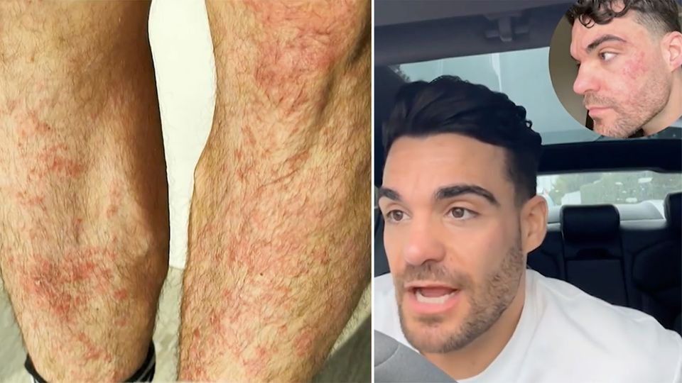 Viele Deutsche sind von der Hautkrankheit betroffen, so auch der bekannte Influencer Stefano Zarrella. Dagegen gibt es inzwischen ein Medikament, das Zarrella ausgestestet hat.