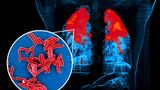 Krankheitserreger Tuberkulose Bakterien und befallene Lungen koloriertes Röntgenbild