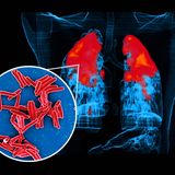 Krankheitserreger Tuberkulose Bakterien und befallene Lungen koloriertes Röntgenbild