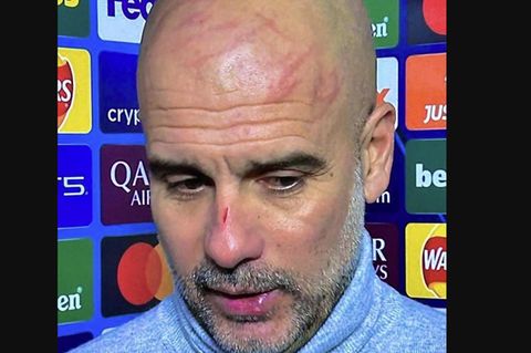 Pep Guardiola, Trainer von Manchester City, war während des Spiels so verzweifelt, dass er sich den Kopf zu stark raufte