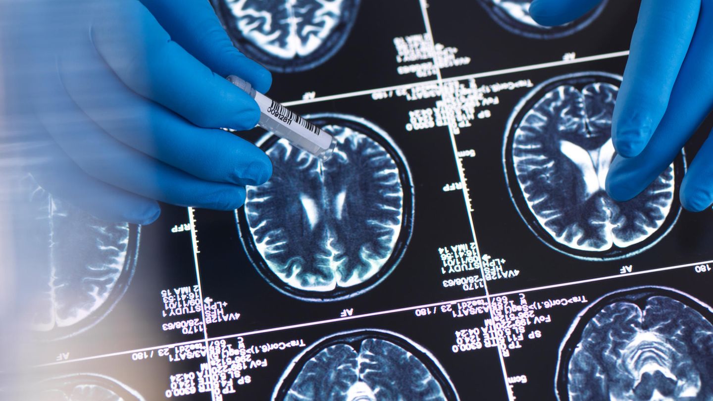 Alzheimer Forschung fürs Gehirn