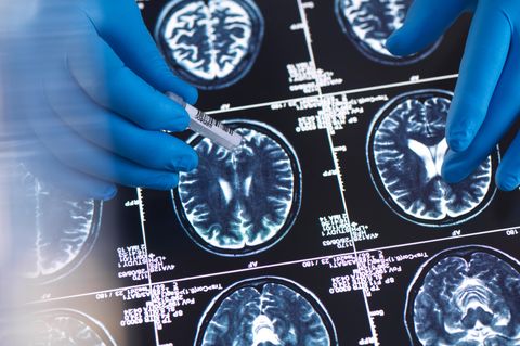 Alzheimer Forschung fürs Gehirn