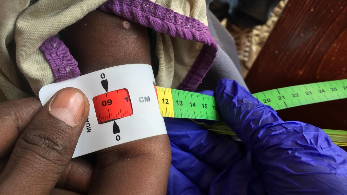 Somalia: Ein Arzt misst den Armumfang eines unterernährten Babys
