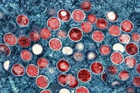 Eine eingefärbte Mikroskopaufnahme von Mpox-Partikeln