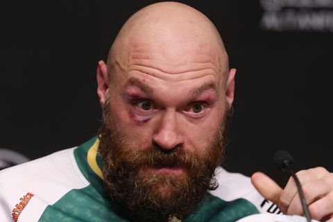 Tyson Fury mit kleinen Blessuren im Gesicht
