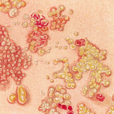 Schlummerndes Virus: Warum die Gürtelrose so unterschätzt wird