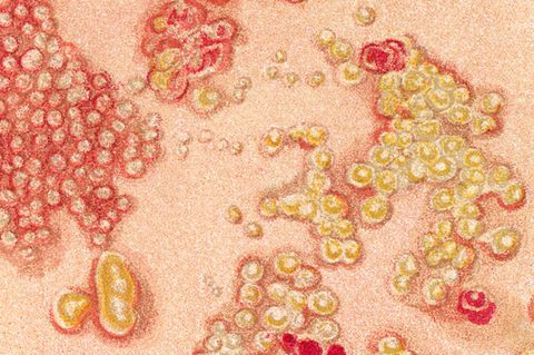 Schlummerndes Virus: Warum die Gürtelrose so unterschätzt wird
