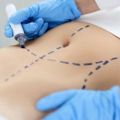 Ausgezeichnete Ärzte im Bereich Bauchdeckenstraffung