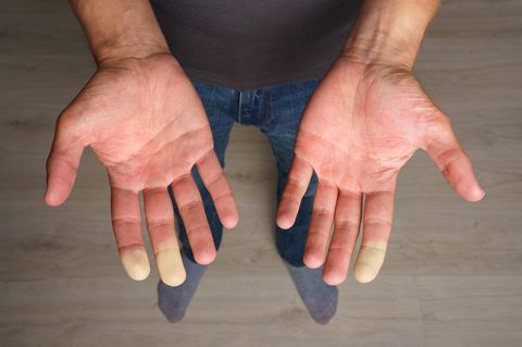 Hautverfärbungen Raynaud