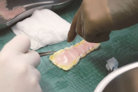 Ein Herzpflaster wird für die Implantation vorbereitet