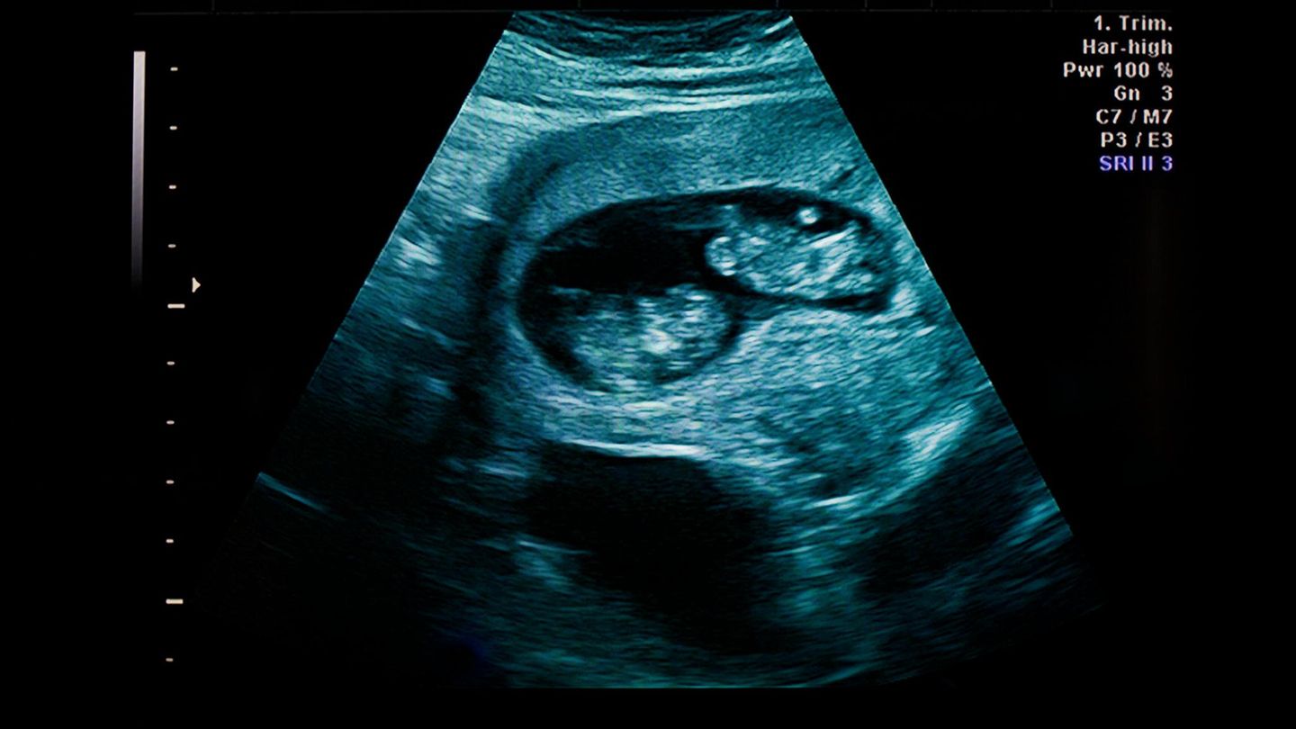 Symbolbild selektive Abreibung: Ein Ultraschallbild von Zwillingen