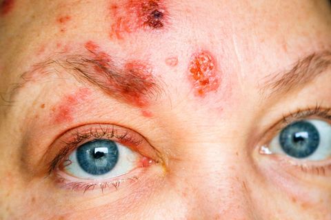 Der wohl schlimmste Fall einer Gürtelrose ist der Krankheitsverlauf im Gesicht. Neben unsäglichen Schmerzen kann es zur Erblindung oder Verlust des Gehörs kommen.