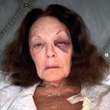 Vip-News: Designerin Diane von Fürstenberg erschrickt Fans mit Veilchen