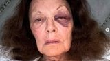 Vip-News: Designerin Diane von Fürstenberg erschrickt Fans mit Veilchen