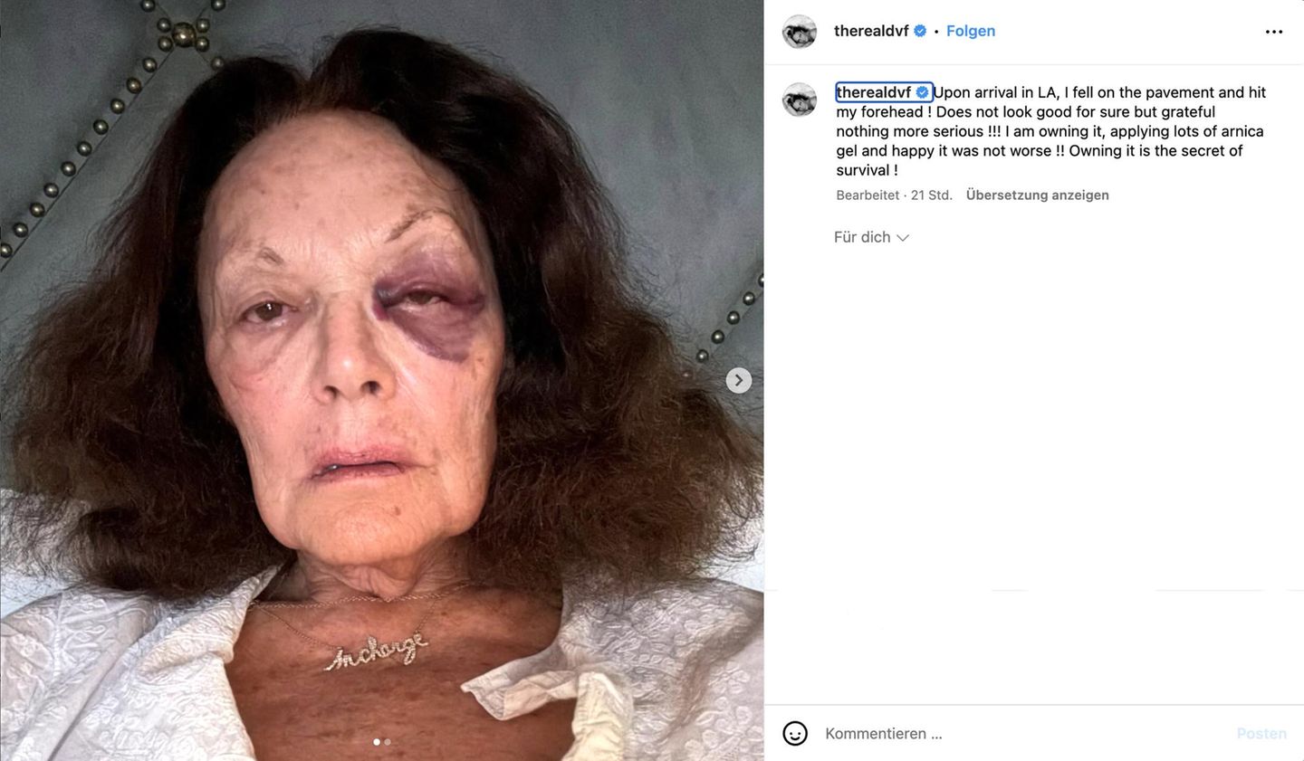 26. Februar 2025: Designerin Diane von Fürstenberg erschrickt Fans mit fiesem Veilchen Vip-News: Designerin Diane von Fürstenberg erschrickt Fans mit Veilchen