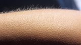 Körper: Gänsehaut