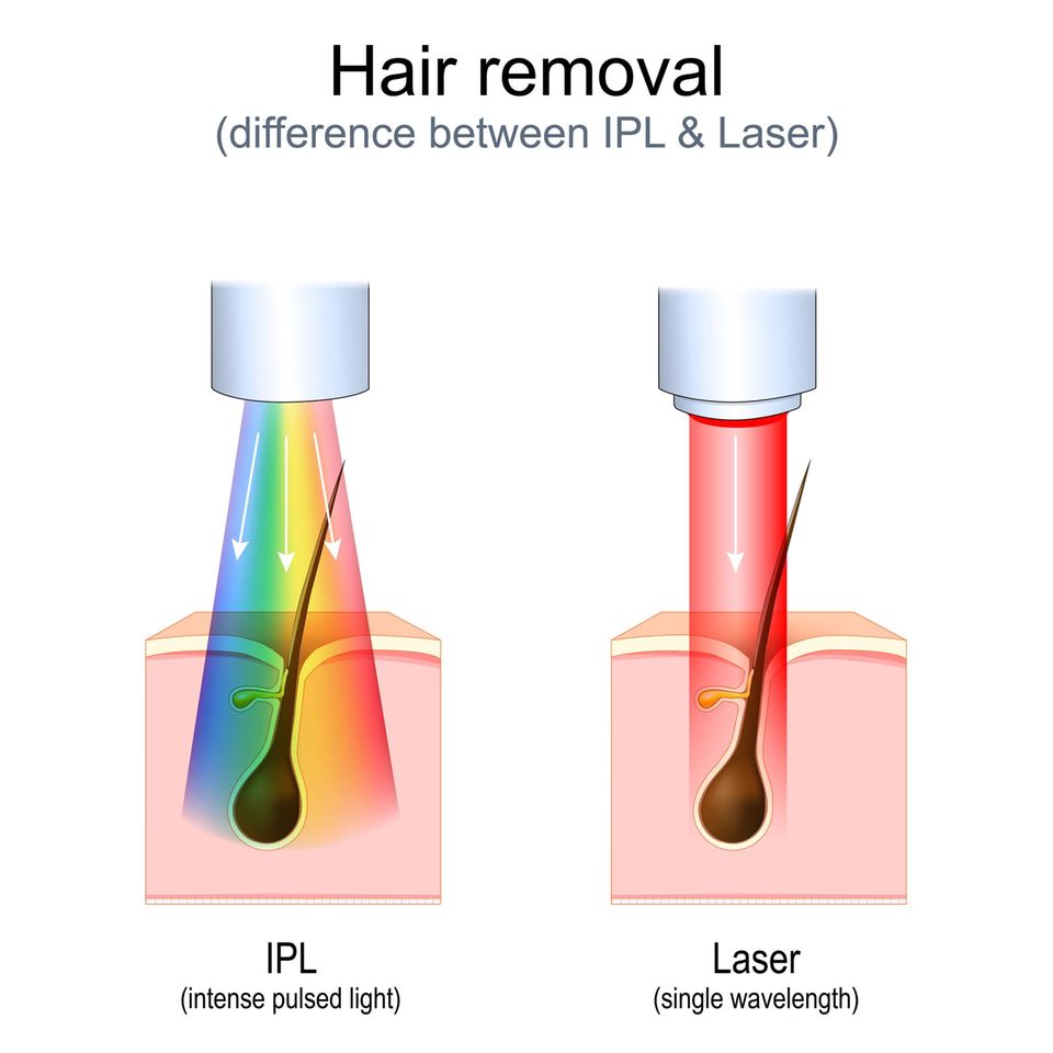 IPL vs. Laser