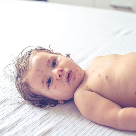 Masern sind keine harmlose Krankheit. Besonders gefährdet sind Kinder, sie leiden häufiger unter schweren Komplikationen wie der Gehirnentzündung 