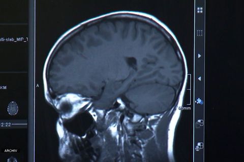 Zahl der Parkinson-Erkrankungen könnte drastisch steigen
