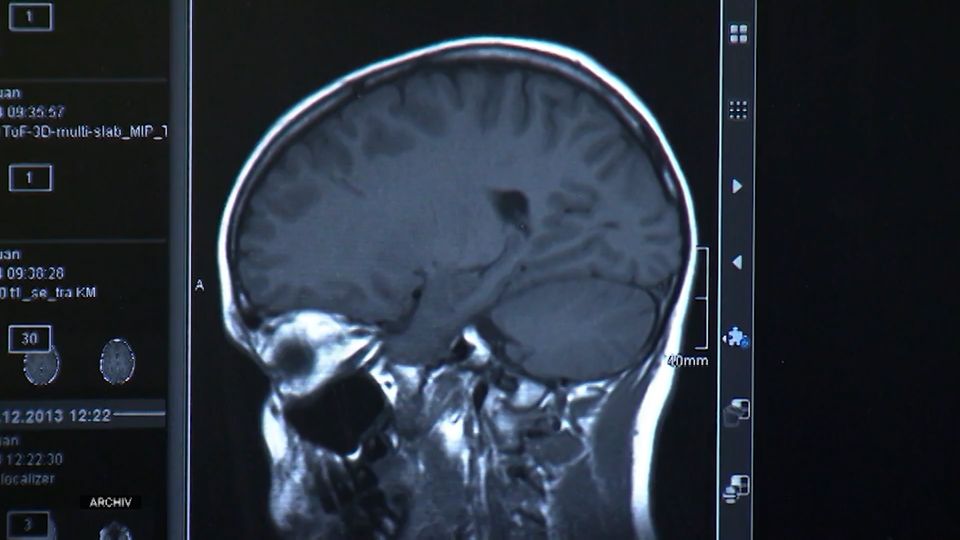 Zahl der Parkinson-Erkrankungen könnte drastisch steigen