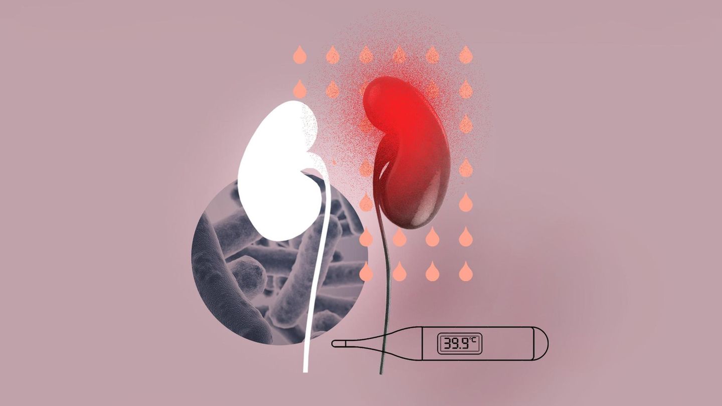 Illustration für die Diagnose Luftniere