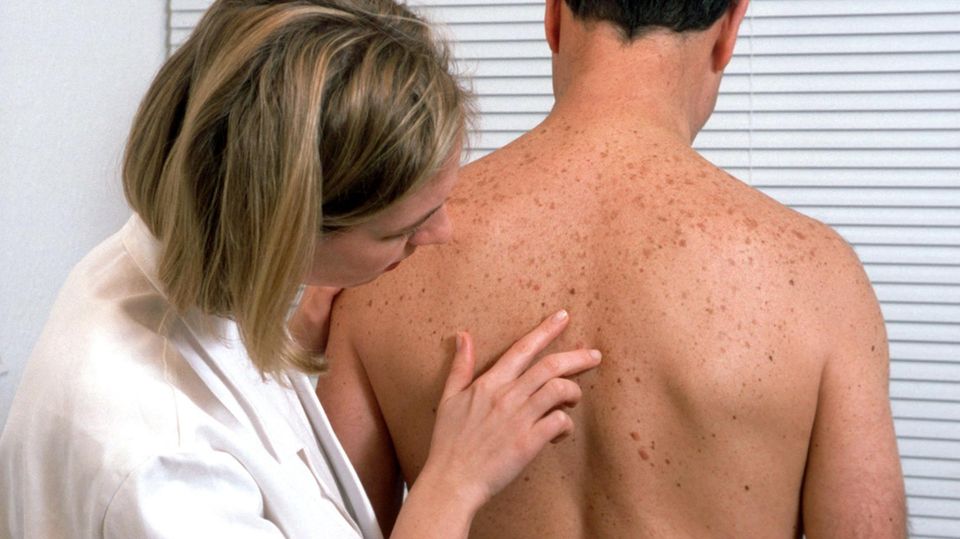 Das sagen Hautärzte zum drastischen Anstieg von Hautkrebs-Fällen Eine Ärztin untersucht die Muttermale auf dem Rücken eines Mannes