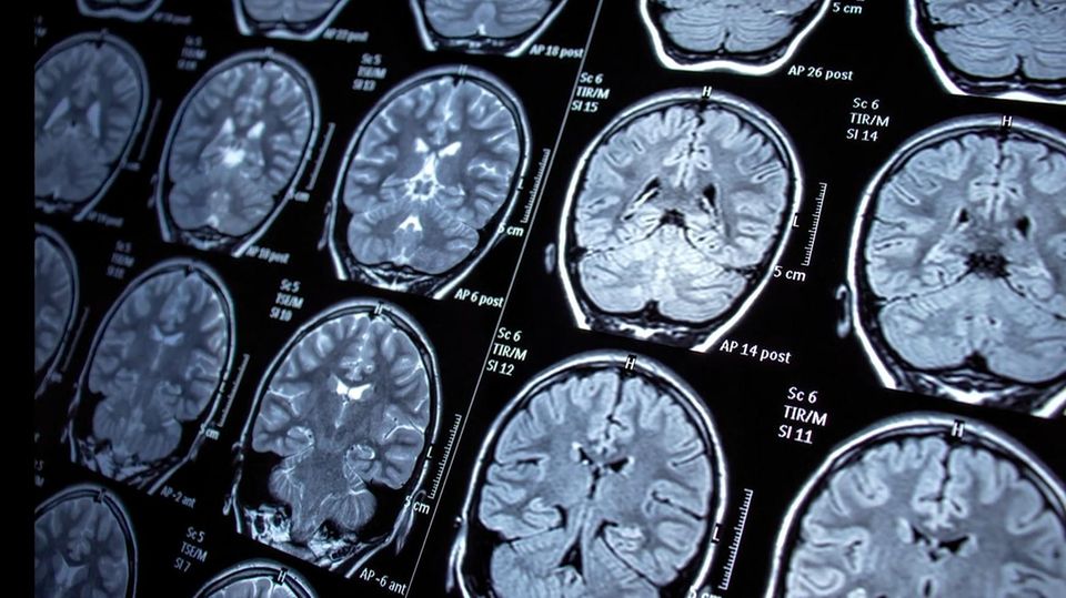 Neuer Schnelltest analysiert Hirntumore im Eiltempo